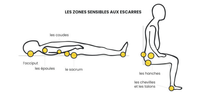 Escarre D Finition Causes Et Traitements Amaelles